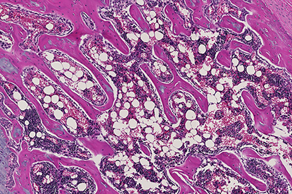 Microscopy image of cancer pathology tissue